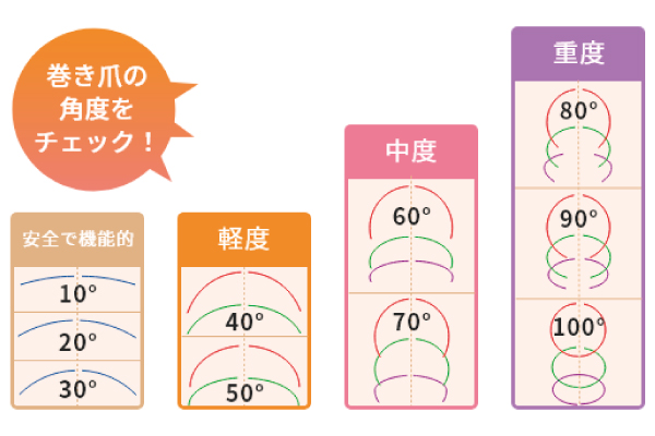 巻き爪の度合い検査