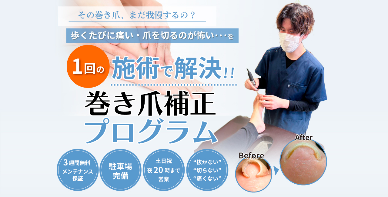 甲斐市で1回の施術で巻き爪を改善する!特別な巻き爪補正プログラム