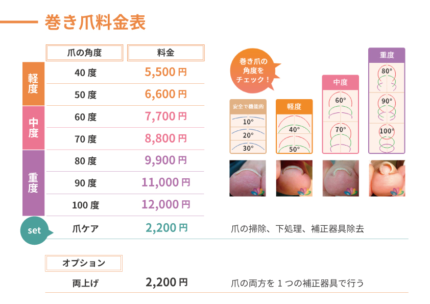 巻き爪料金表