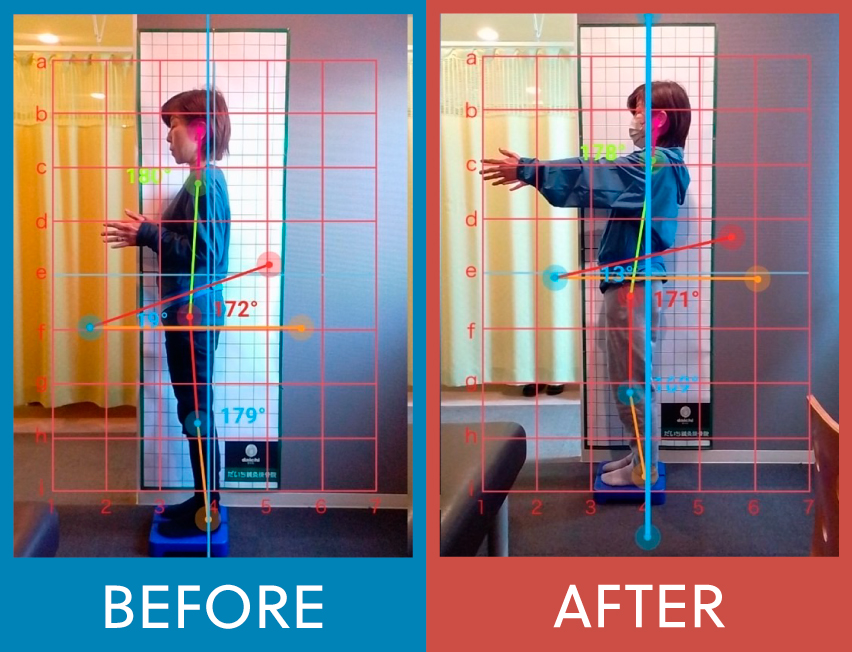 施術後の骨盤角度変化